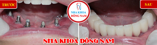 Cấy ghép Implant Tại nha khoa Đông Nam