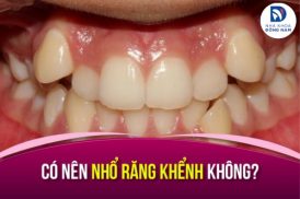 Có nên nhổ răng khểnh không? Giải đáp từ Nha Sĩ