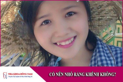 có nên nhổ răng khểnh không