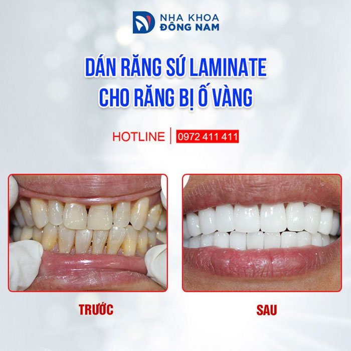 Dán răng sứ với tỷ lệ mài răng rất thấp giúp bảo tồn răng thật tối ưu