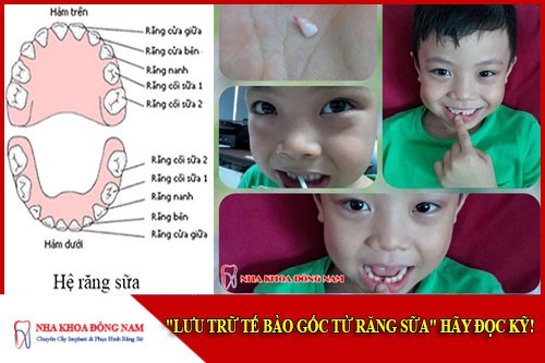 Lưu trữ tế bào gốc từ răng sữa