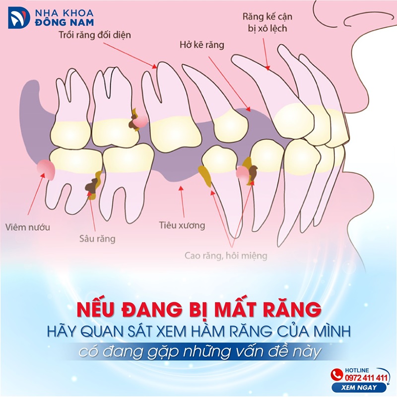 Mất răng hàm để lại nhiều hậu quả nghiêm trọng