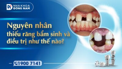 Nguyên nhân thiếu răng bẩm sinh và phương pháp điều trị