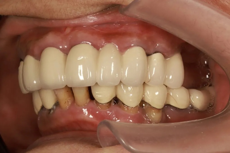 Tiêu xương khiến cầu răng sứ bị hở