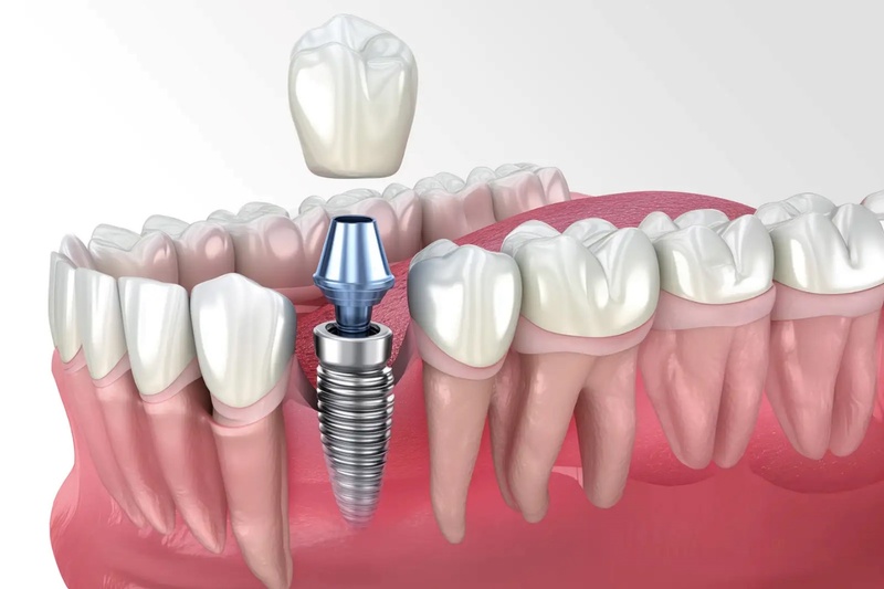 Trồng răng cấm bằng phương pháp cấy ghép Implant