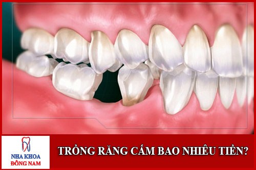 Trồng răng cấm bao nhiêu tiền