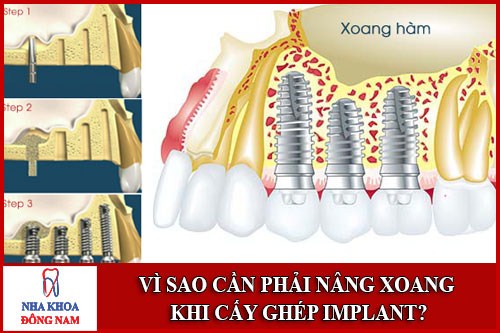 Vì sao phải nâng xoang khi cấy ghép Implant