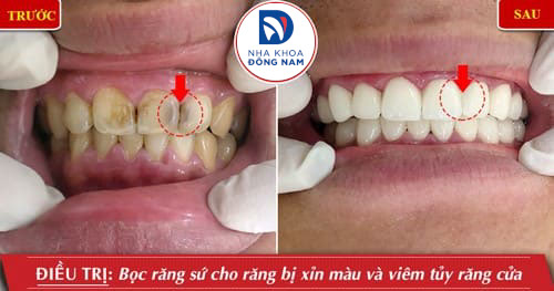 Bọc răng sứ điều trị hôi miệng