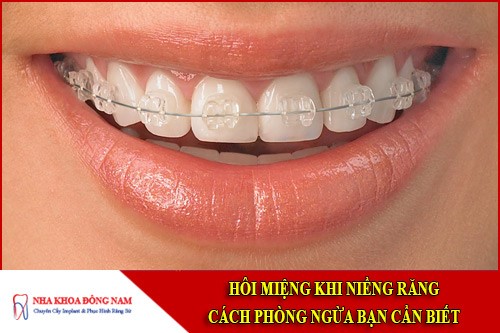 Cách phòng ngừa hôi miệng khi niềng răng