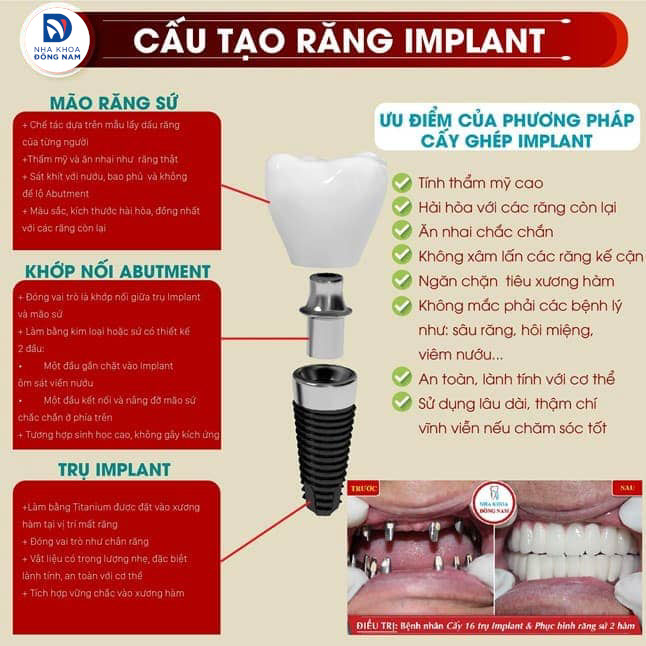 Thay thế hàm giả tháo lắp bằng cấy ghép răng Impla