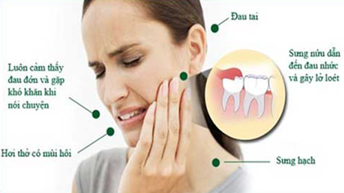 răng khôn và các tác hại gây ra