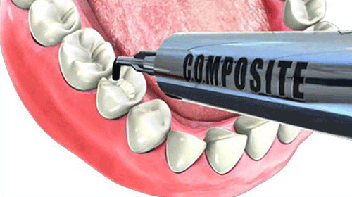 phương pháp trám răng bằng composite