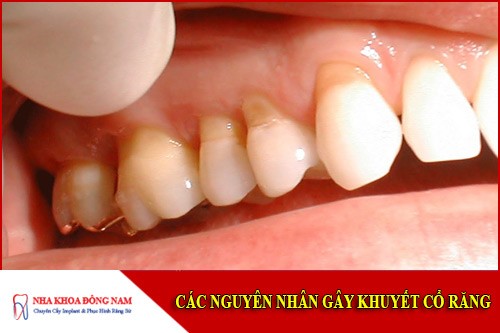 các nguyên nhân gây khuyết cổ răng