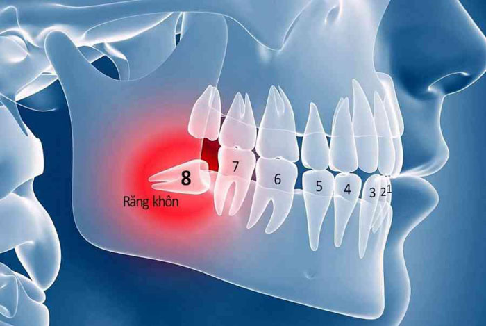 Răng khôn là chiếc răng mọc cuối cùng nằm sâu bên trong cung hàm