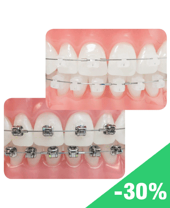 Chỉnh nha niềng răng tại nha khoa đông nam