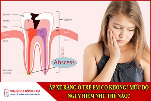 áp xe răng ở trẻ em có không? Mức độ nguy hiểm như thế nào?