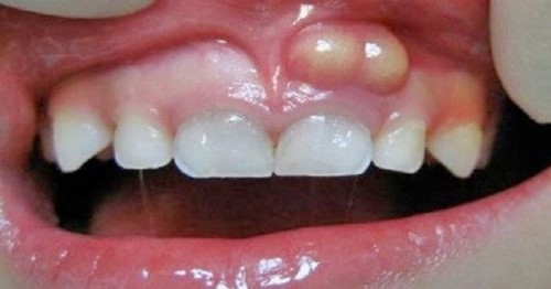 áp xe răng ở trẻ em có không?