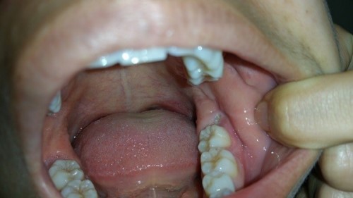 mọc răng khôn gây đau nhức răng