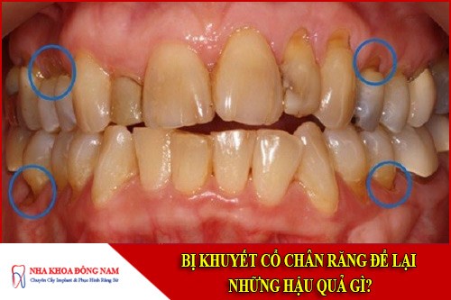 bị khuyết cổ chân răng để lại những hậu quả gì