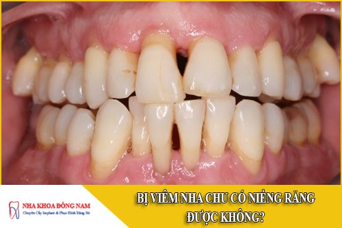 bị viêm nha chu có niềng răng được không