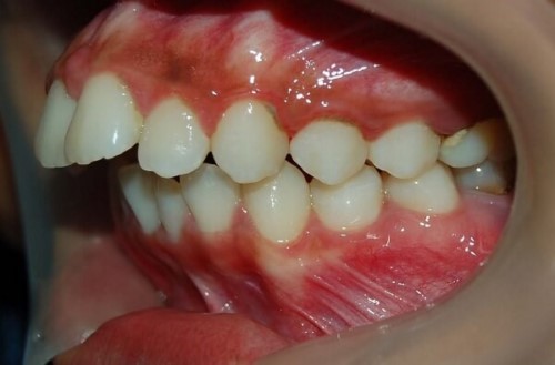 viêm nha chu niềng răng được không