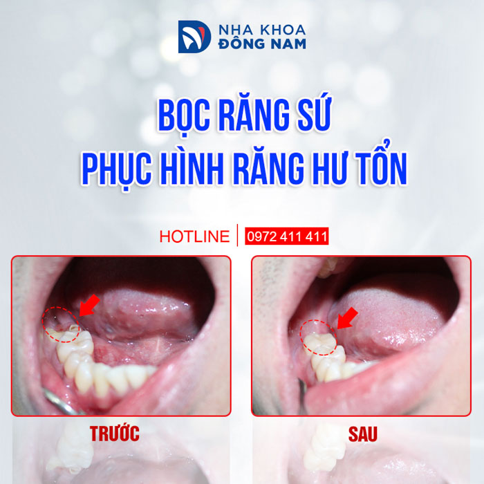 Bọc răng sứ phục hình răng bị hư tổn