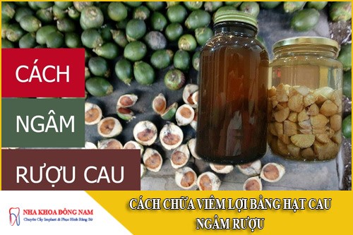 cách chữa viêm lợi bằng hạt cau ngâm rượu