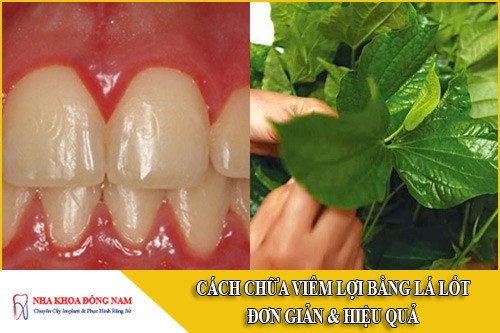 cách chữa viêm lợi bằng lá lốt