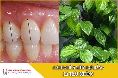 cách chữa viêm lợi bằng lá trầu không