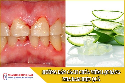 cách chữa viêm lợi bằng nha đam