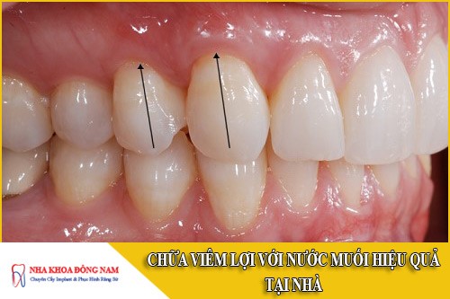 cách chữa viêm lợi với nước muối hiệu quả tại nhà