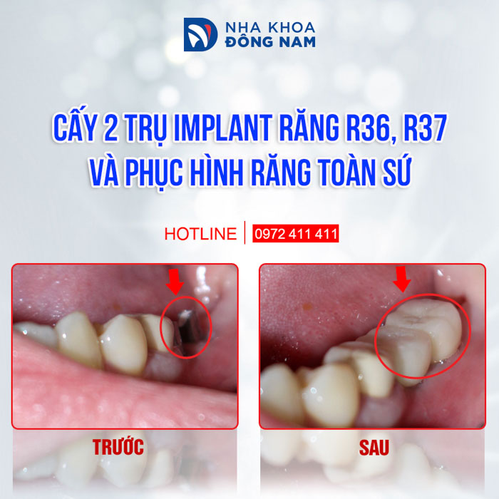 Cấy ghép Implant giúp phục hình răng mất tốt nhất hiện nay