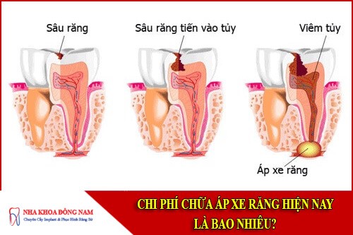 chi phí chữa áp xe răng hiện nay là bao nhiêu