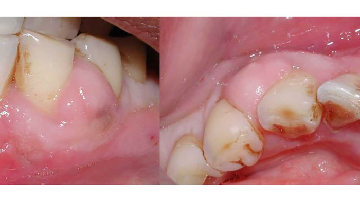 Chi phí trị áp xe răng phụ thuộc vào nhiều yếu tố khác nhau