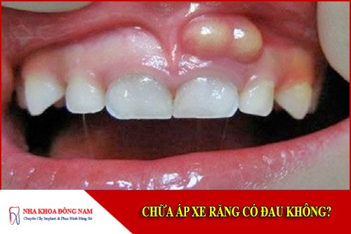 chữa áp xe răng có đau không