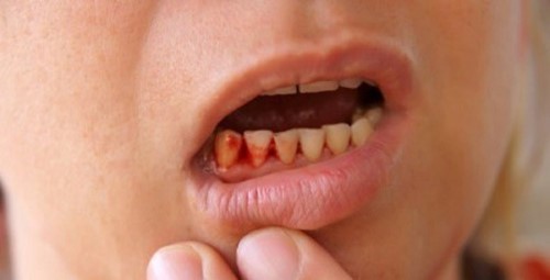 đau nhức răng