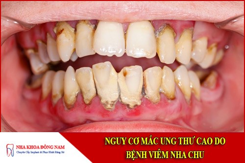 nguy cơ mắc ung thư cao do bệnh viêm nha chu