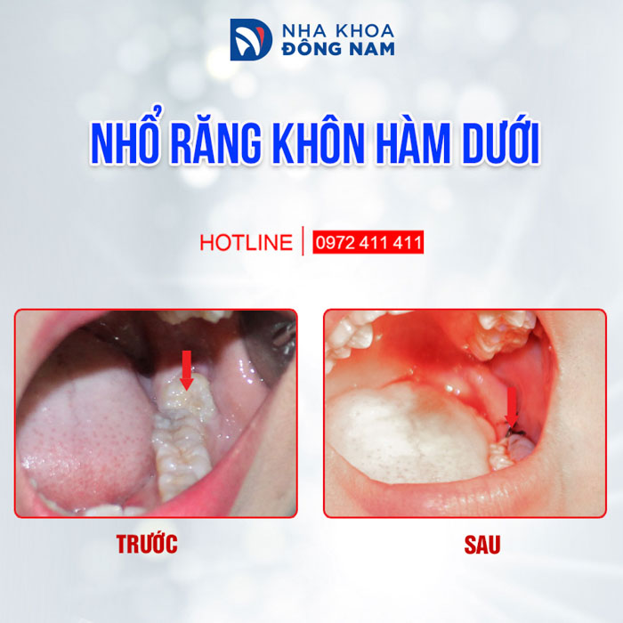 Nhổ răng khôn mọc lệch