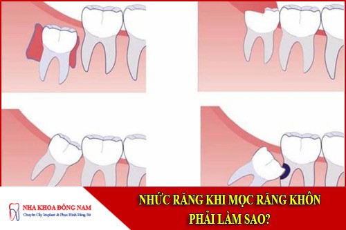 nhức răng khi mọc răng khôn thì phải làm sao