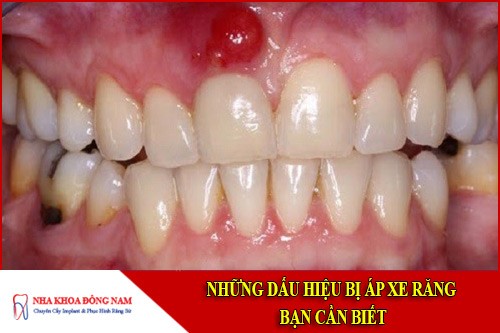 những dấu hiệu bị áp xe răng
