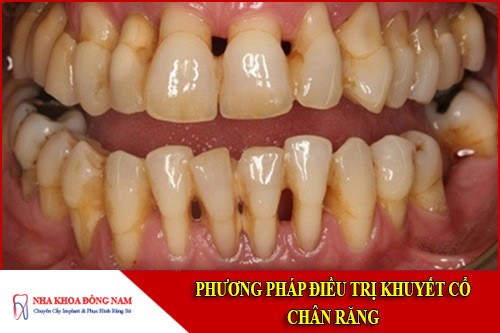 phương pháp điều trị khuyết cổ chân răng