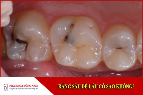 răng sâu để lâu có sao không
