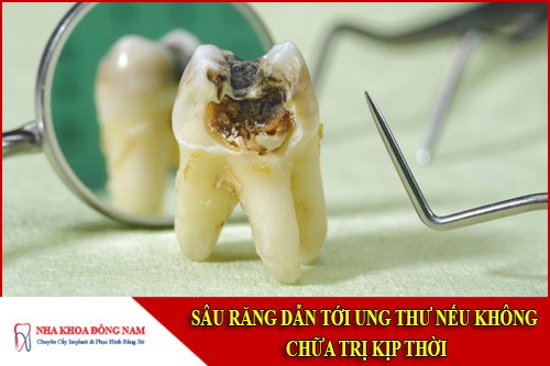 sâu răng dẫn tới ung thư nếu không chữa trị kịp thời
