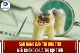 sâu răng dẫn tới ung thư nếu không chữa trị kịp thời