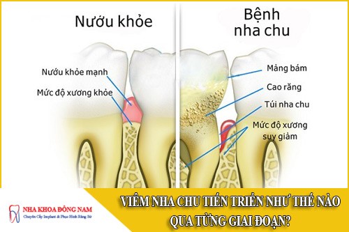 viêm nha chu tiến triển như thế nào qua từng giai đoạn