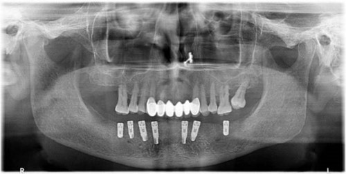 trụ implant cấy vào xương hàm