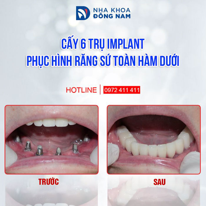 Implant All On 6 cho ưu điểm vượt trội về ăn nhai và thẩm mỹ