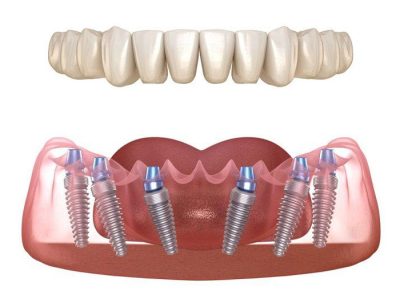 Cấy ghép Implant All On 6 là gì? Giá bao nhiêu?