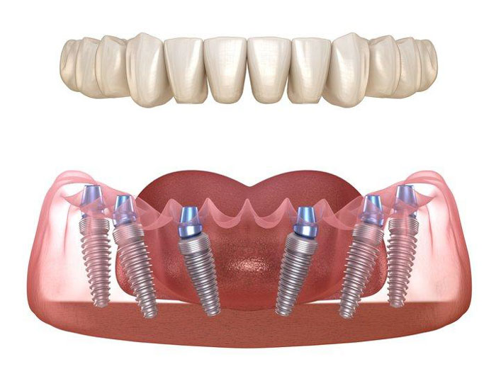 Kỹ thuật cấy ghép Implant All On 6