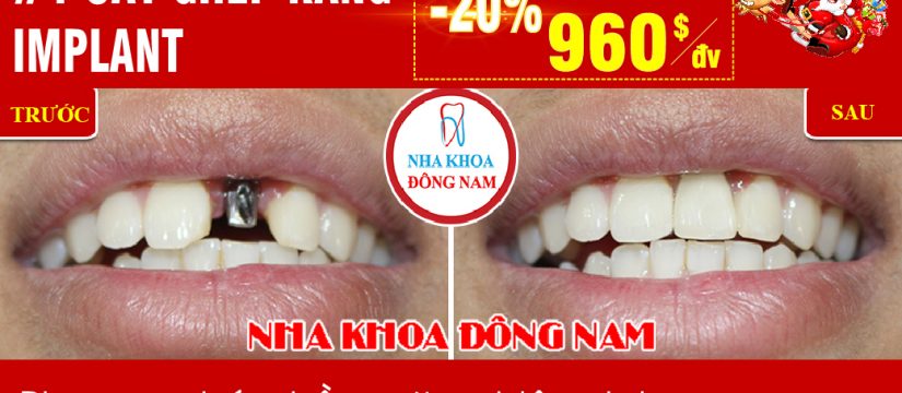 Khuyến mãi cấy ghép răng Implant nhân dịp noel và tết tây 2019